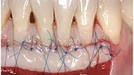 soft tissue graft mandible sutured