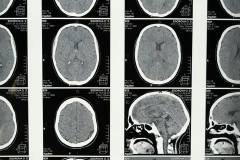 Medical Imaging of the Brain 