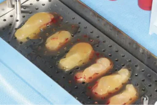 Surgical tray with fresh PRF preparations
