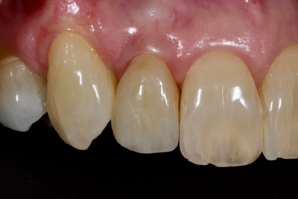 Close up view of the upper teeth and gumline.