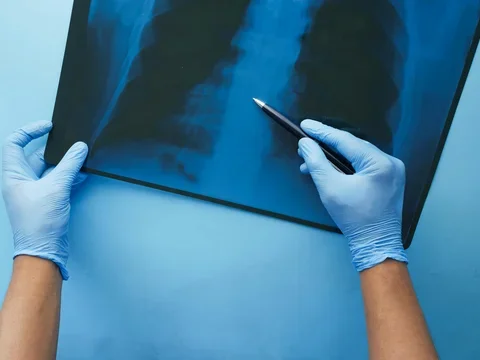 Hands pointing at lung X-ray